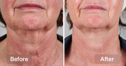 Perfect Neck Wrinkle Care Set