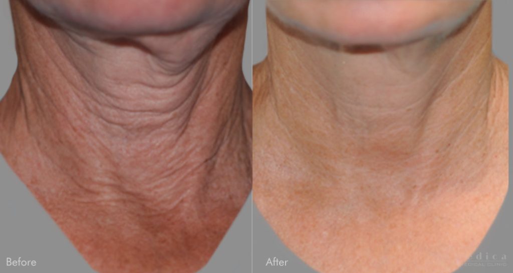 Perfect Neck Wrinkle Care Set