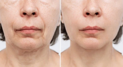 Perfect Neck Wrinkle Care Set