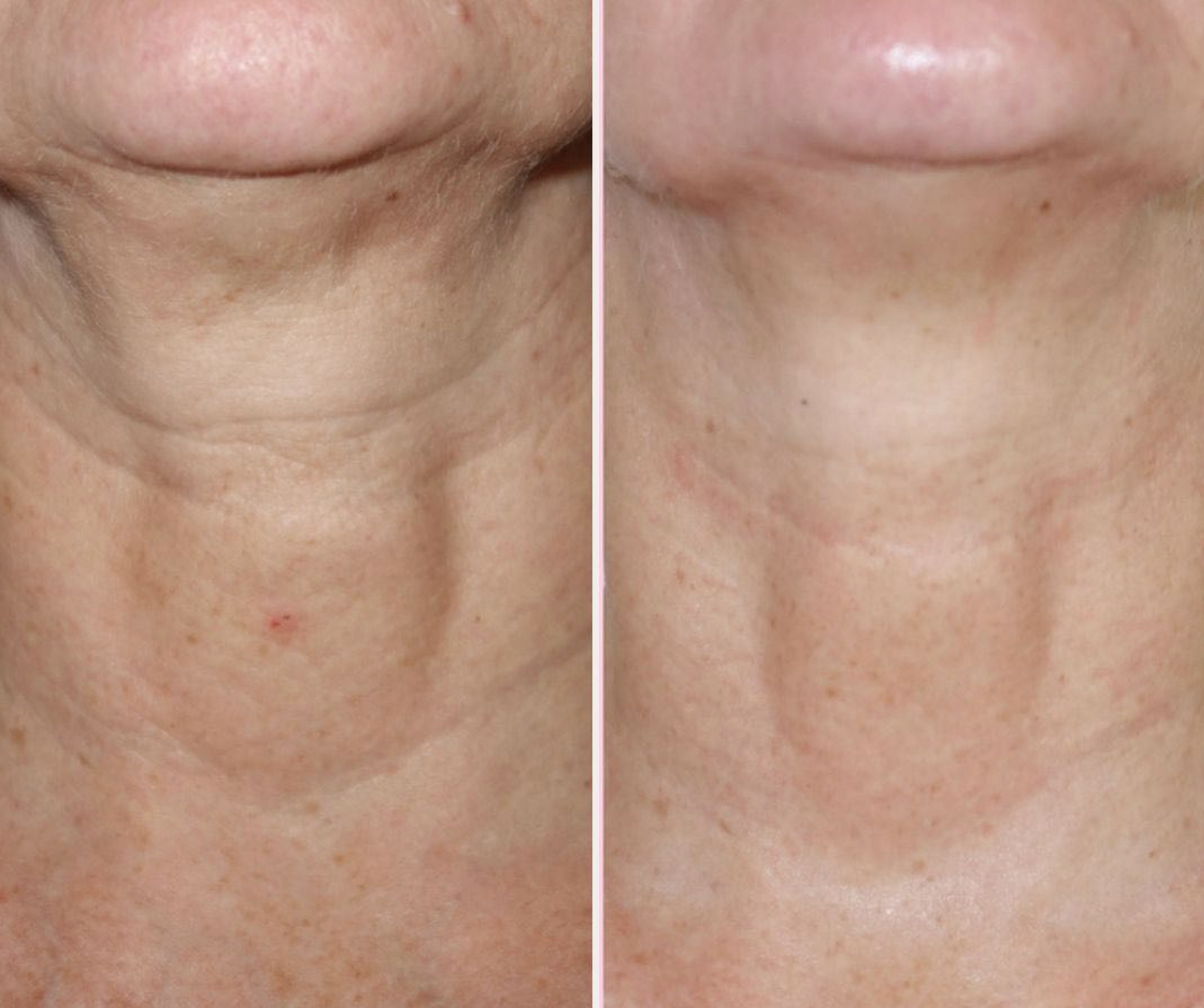 Perfect Neck Wrinkle Care Set