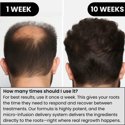 Agelessory™ Hair Regrowth System